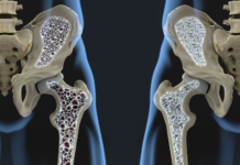 Unraveling Osteoporosis: Understanding, Preventing, and Managing the Silent Disease