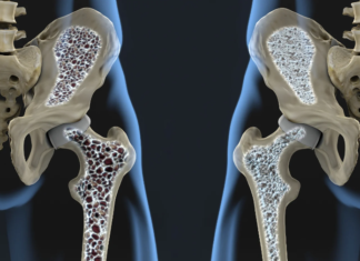 Unraveling Osteoporosis: Understanding, Preventing, and Managing the Silent Disease