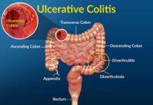 Unraveling Ulcerative Colitis: Understanding, Managing, and Thriving with a Chronic Inflammatory Bowel Disease