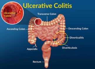 Unraveling Ulcerative Colitis: Understanding, Managing, and Thriving with a Chronic Inflammatory Bowel Disease