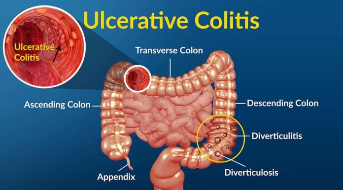 Unraveling Ulcerative Colitis: Understanding, Managing, and Thriving with a Chronic Inflammatory Bowel Disease